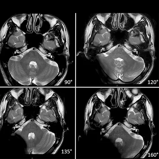 mri 3d cochlear test